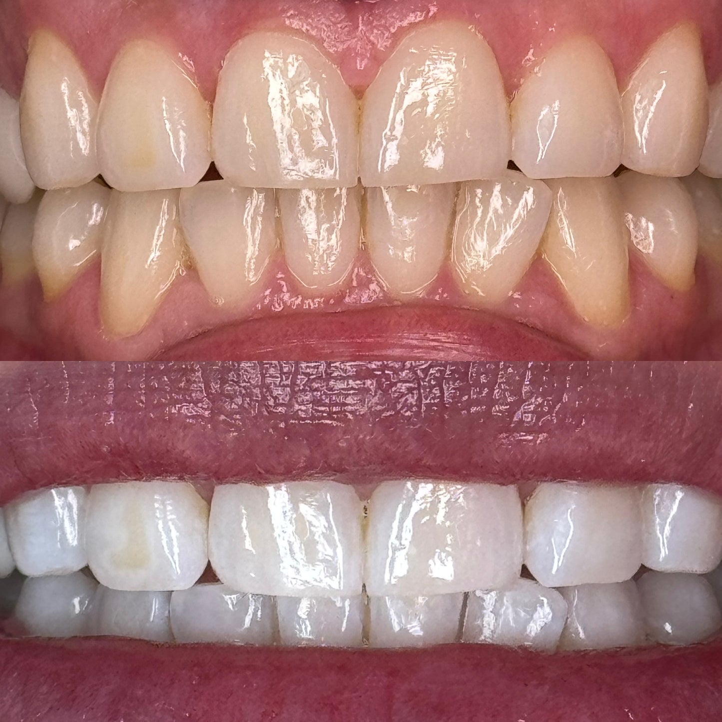 Teeth Whitening Gels